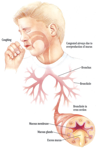 약업신문]기관지염(Bronchitis)